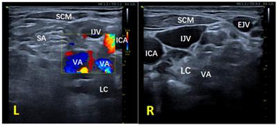 Ultrasound-guided stellate ganglion blockade – patient positioning is everything: a case report demonstrating the efficacy of a modified out-of-plane approach
